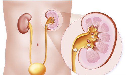 人体为什么会长出结石？主要源自这5个坏习惯